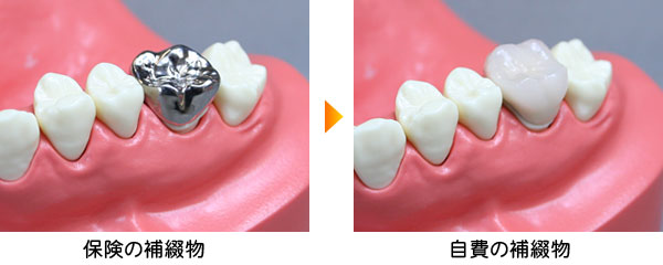 保険の補綴物と自費の補綴物の違い